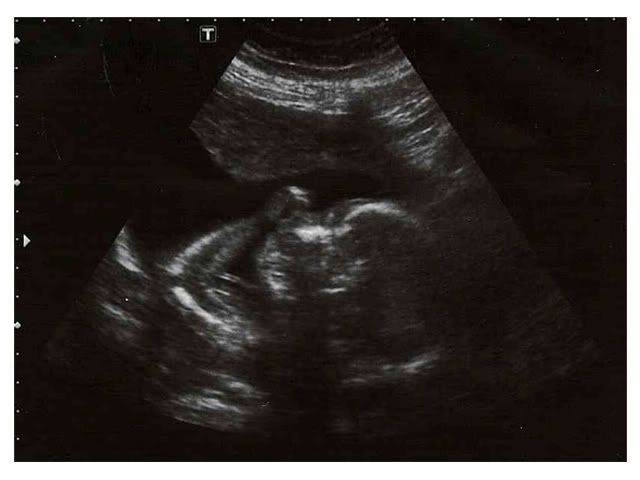 BabyBrotherUltrasoundSide_10jun2011.jpg