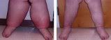 lymphedema