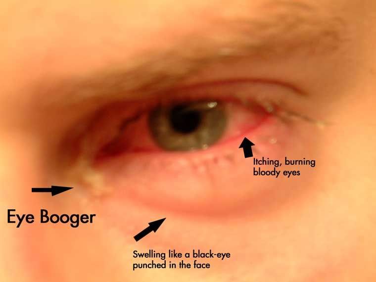 pink eye infection. Pink eye is a condition for