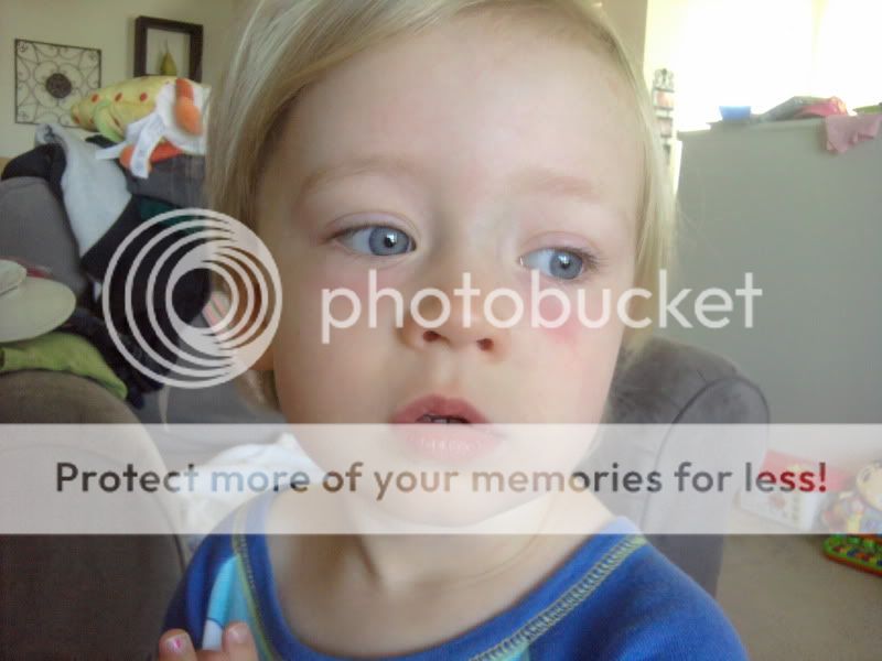 Red under eyes JustMommies Message Boards